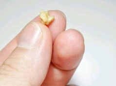 If These Objects Come Out From Your Mouth After Coughing, This Is What It Means