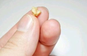 If These Objects Come Out From Your Mouth After Coughing, This Is What It Means