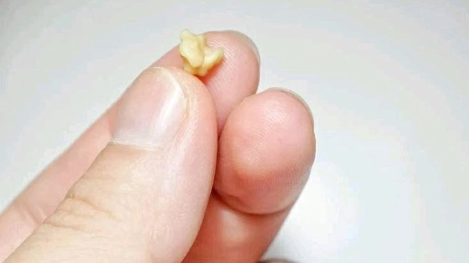If These Objects Come Out From Your Mouth After Coughing, This Is What It Means