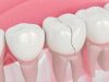 (Opinion) How To Remove Deep Brown Stains From Your Teeth With These Kitchen Ingredients