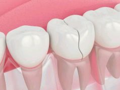 (Opinion) How To Remove Deep Brown Stains From Your Teeth With These Kitchen Ingredients