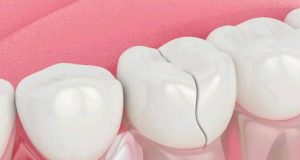 (Opinion) How To Remove Deep Brown Stains From Your Teeth With These Kitchen Ingredients