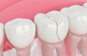 (Opinion) How To Remove Deep Brown Stains From Your Teeth With These Kitchen Ingredients