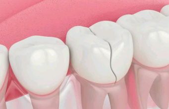 (Opinion) How To Remove Deep Brown Stains From Your Teeth With These Kitchen Ingredients