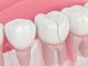 (Opinion) How To Remove Deep Brown Stains From Your Teeth With These Kitchen Ingredients