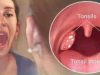 How To Cure Tonsillitis In 4 Hours, Fast And Easy.
