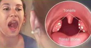 How To Cure Tonsillitis In 4 Hours, Fast And Easy.