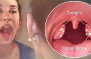 How To Cure Tonsillitis In 4 Hours, Fast And Easy.