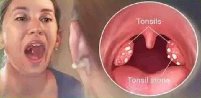 How To Cure Tonsillitis In 4 Hours, Fast And Easy.