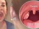 How To Cure Tonsillitis In 4 Hours, Fast And Easy.