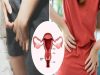 Vaginal Cancer: The Early Symptoms Females Should Not Ignore