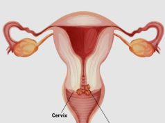 Cervical Cancer: The Silent Disease Every Woman Should Be Aware Of.