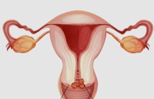 Cervical Cancer: The Silent Disease Every Woman Should Be Aware Of.