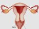 Cervical Cancer: The Silent Disease Every Woman Should Be Aware Of.