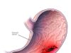 4 Fruits To Eat To Make Blood Flow Very Well In Your Body