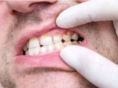 Causes of tooth decay – prevention and treatment options | Opinion