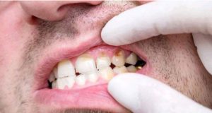 Causes of tooth decay – prevention and treatment options | Opinion