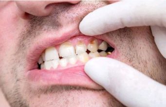 Causes of tooth decay – prevention and treatment options | Opinion