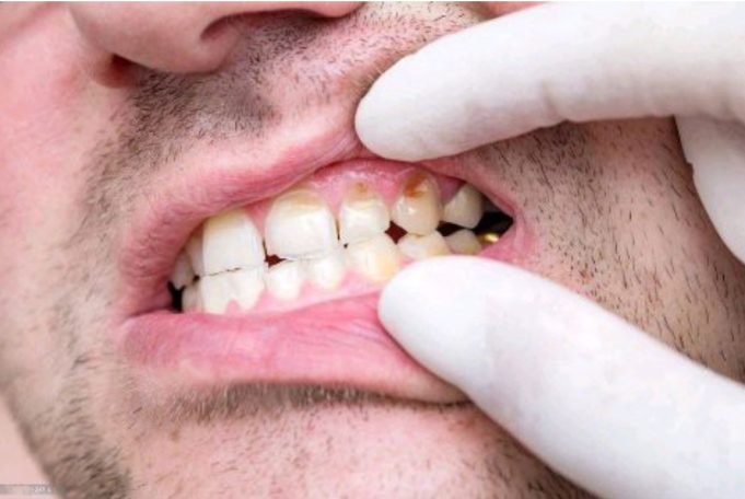 Causes of tooth decay – prevention and treatment options | Opinion