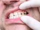 Causes of tooth decay – prevention and treatment options | Opinion