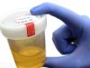 Warning Signs in Your Urine That Could Signal Kidney Trouble