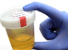 Warning Signs in Your Urine That Could Signal Kidney Trouble