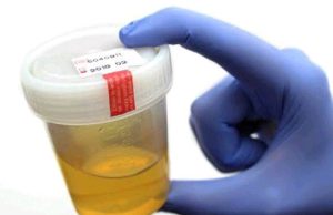 Warning Signs in Your Urine That Could Signal Kidney Trouble