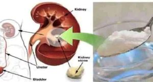 Repair Kidney Damage Quickly with Just One Teaspoon of a Common Household Ingredient