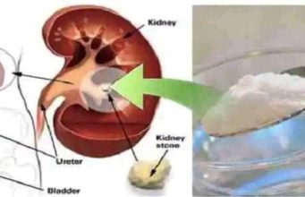 Repair Kidney Damage Quickly with Just One Teaspoon of a Common Household Ingredient